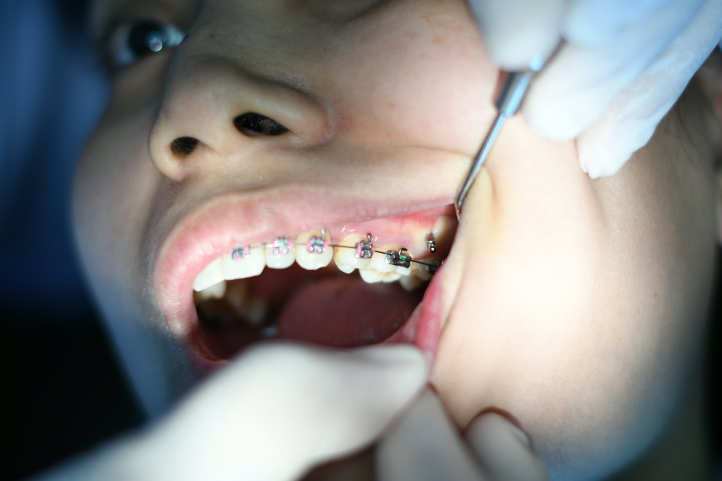 Manos enguantadas de dentista ajustando brackets en los dientes de un paciente.